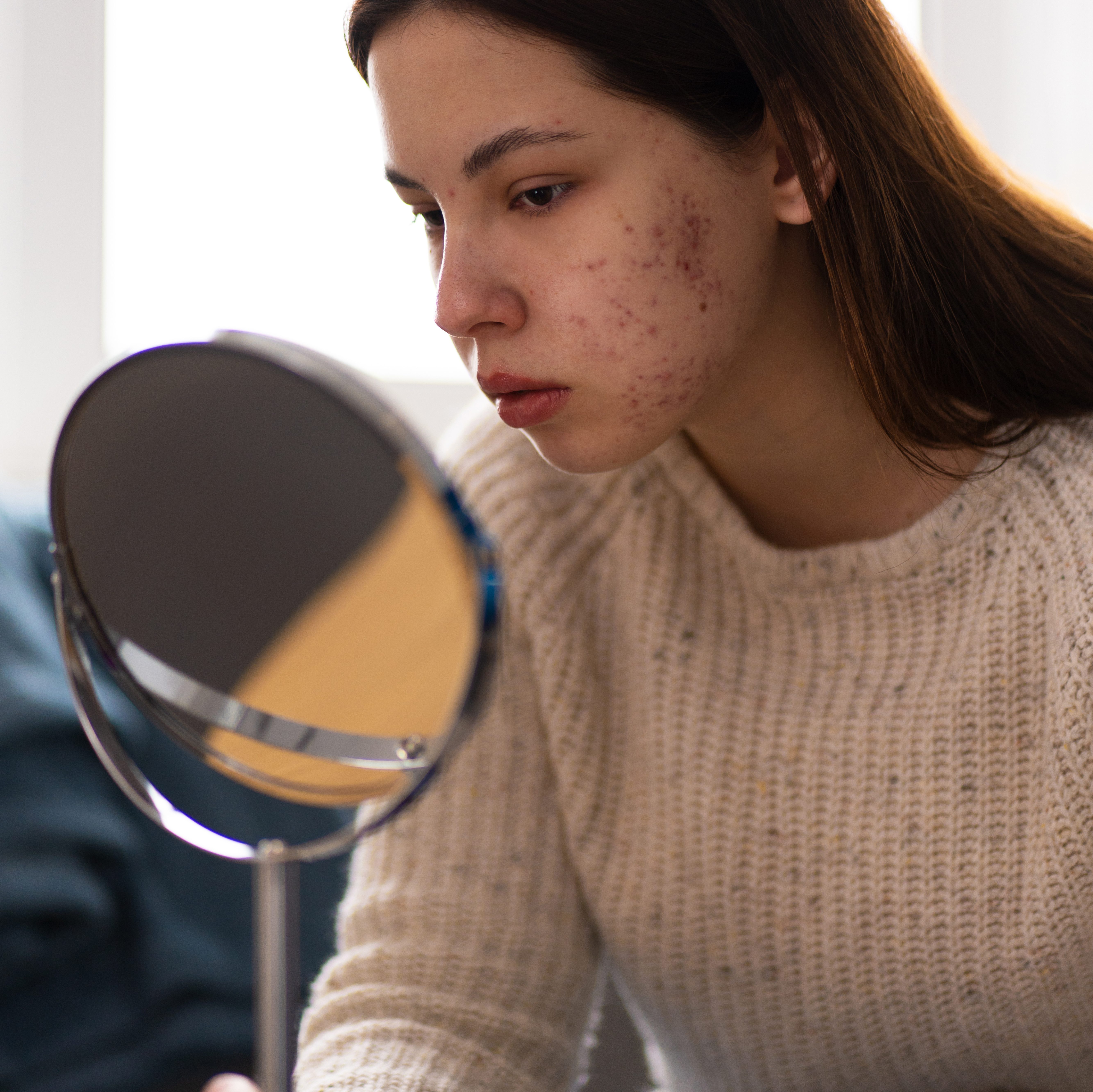 person-dealing-with-rosacea